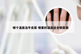哪个温泉治牛皮屑 哪里的温泉适合银屑病