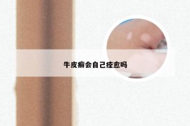 牛皮癣会自己痊愈吗