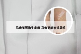 马齿苋可治牛皮癣 马齿苋能治银屑吗