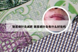 银屑病针灸减肥 银屑病针灸有什么好处吗