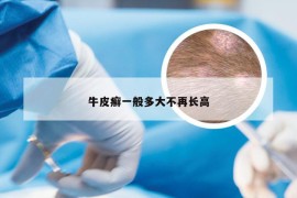 牛皮癣一般多大不再长高