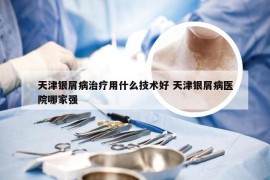 天津银屑病治疗用什么技术好 天津银屑病医院哪家强