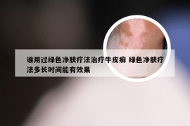 谁用过绿色净肤疗法治疗牛皮癣 绿色净肤疗法多长时间能有效果