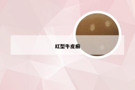 红型牛皮癣