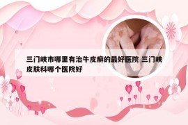 三门峡市哪里有治牛皮癣的最好医院 三门峡皮肤科哪个医院好