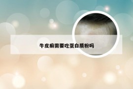 牛皮癣需要吃蛋白质粉吗