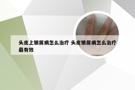 头皮上银屑病怎么治疗 头皮银屑病怎么治疗最有效
