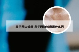 鼻子两边长癣 鼻子两边长癣用什么药