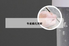 牛皮癣几天好