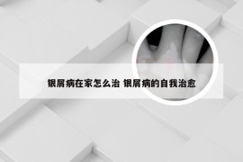 银屑病在家怎么治 银屑病的自我治愈