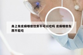 身上有皮癣哪些饮食不可以吃吗 皮癣哪些东西不能吃