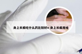 身上长癣吃什么药比较好n 身上长癣用啥