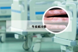 牛皮癣冷敷