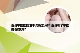 南昌中医医院治牛皮癣怎么样 南昌哪个中医院看皮肤好