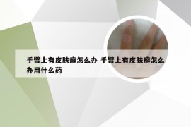 手臂上有皮肤癣怎么办 手臂上有皮肤癣怎么办用什么药