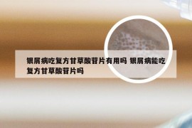 银屑病吃复方甘草酸苷片有用吗 银屑病能吃复方甘草酸苷片吗