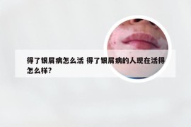 得了银屑病怎么活 得了银屑病的人现在活得怎么样?
