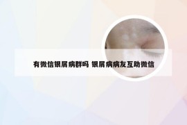有微信银屑病群吗 银屑病病友互助微信