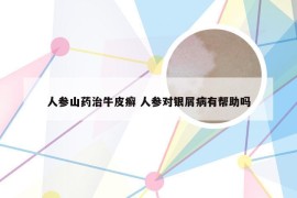人参山药治牛皮癣 人参对银屑病有帮助吗