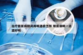 治疗银屑病期间再喝酒会怎样 银屑病喝一点酒好吗