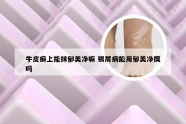 牛皮癣上能抹郁美净嘛 银屑病能用郁美净摸吗