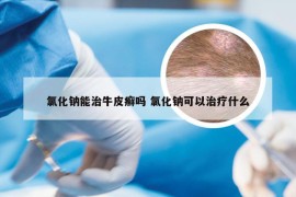 氯化钠能治牛皮癣吗 氯化钠可以治疗什么