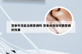 苦参外洗能治银屑病吗 苦参水泡浴对银屑病的效果