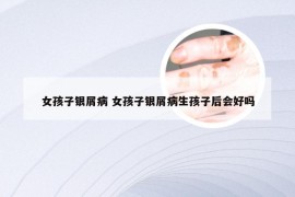 女孩子银屑病 女孩子银屑病生孩子后会好吗