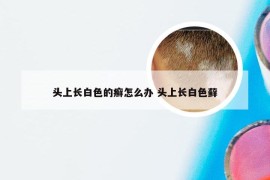 头上长白色的癣怎么办 头上长白色藓