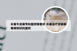长春牛皮癣专科医院哪里好 长春治疗皮肤癣瘙痒较好的医院