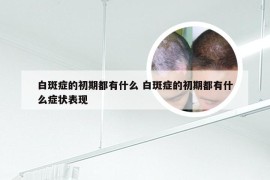 白斑症的初期都有什么 白斑症的初期都有什么症状表现