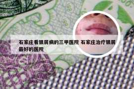 石家庄看银屑病的三甲医院 石家庄治疗银屑最好的医院