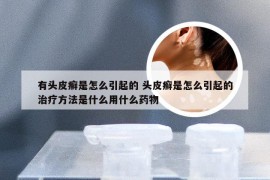 有头皮癣是怎么引起的 头皮癣是怎么引起的治疗方法是什么用什么药物