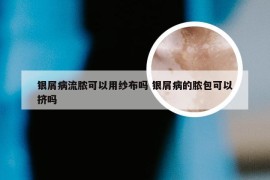 银屑病流脓可以用纱布吗 银屑病的脓包可以挤吗