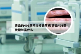 青岛的401医院治疗银屑病 青岛401医院擅长是什么