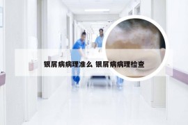 银屑病病理准么 银屑病病理检查