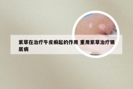 紫草在治疗牛皮癣起的作用 重用紫草治疗银屑病