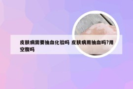 皮肤病需要抽血化验吗 皮肤病用抽血吗?用空腹吗