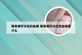 银屑病可以吃的虫蛹 银屑病可以吃的虫蛹是什么