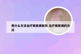 用什么方法治疗银屑病有效 治疗银屑病的方法