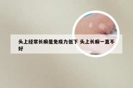 头上经常长癣是免疫力低下 头上长癣一直不好