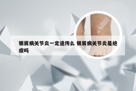 银屑病关节炎一定遗传么 银屑病关节炎是绝症吗