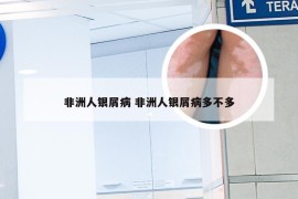 非洲人银屑病 非洲人银屑病多不多