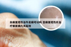白癣夏塔热治牛皮癣可以吗 百癣夏塔热片治疗银屑病几天起效