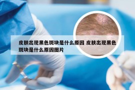 皮肤出现黑色斑块是什么原因 皮肤出现黑色斑块是什么原因图片