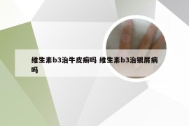 维生素b3治牛皮癣吗 维生素b3治银屑病吗