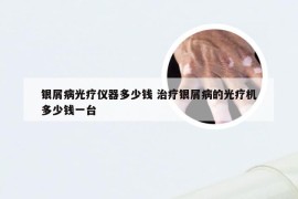 银屑病光疗仪器多少钱 治疗银屑病的光疗机多少钱一台