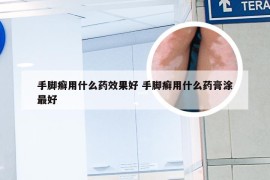 手脚癣用什么药效果好 手脚癣用什么药膏涂最好