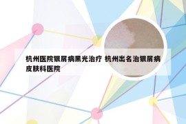 杭州医院银屑病黑光治疗 杭州出名治银屑病皮肤科医院