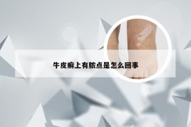 牛皮癣上有脓点是怎么回事